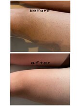 エイチ(H)/メンズ足脱毛