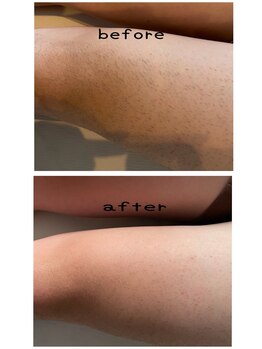 エイチ(H)/メンズ足脱毛