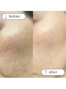 トータルビューティーサロンリア(Li'a)/ビフォー＆アフター