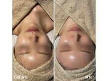 シェリーミル(Cherie Miru)/陶肌トリートメントBefore/After