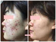 アブソリュートワン(absolute1)/NEW☆バクチ甦生プログラム