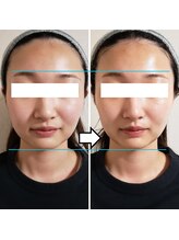 きしの美容整体院/フェイシャルリフトケアBA