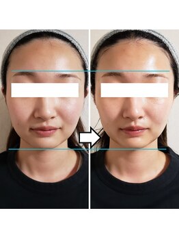 きしの美容整体院/フェイシャルリフトケアBA