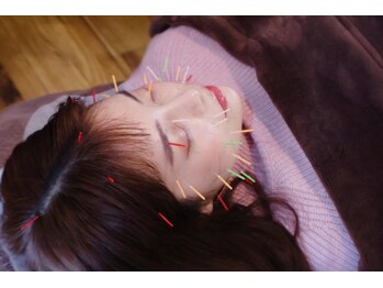 カナヤ鍼灸整骨院/当院人気メニュー！美容鍼
