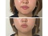 【老若男女に人気！】脂肪分解で二重あご改善！速攻小顔ケア¥22000→