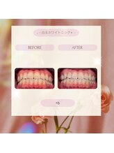 プラスビー 2号店(+b)/ホワイトニングビフォーアフター