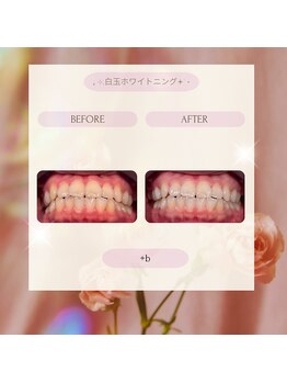 プラスビー 2号店(+b)/ホワイトニングビフォーアフター