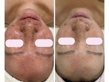 小顔コルギ・美肌サロン Pul Beaute 吉祥寺 [ハーブピーリング / 毛穴洗浄 / ニキビ]の雰囲気（ハーブ50%2回目終了です。赤みが鎮静し毛穴も小さく！）