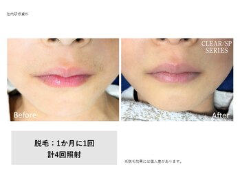 ドルチェビューティーサロン 戸塚安行店(Dolce Beauty Salon)/脱毛（鼻下）_施術4回