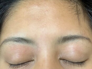 アクネビューティ(ACNE BEAUTY)/ニキビケアafter