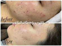 ゴールデンアイ 谷山店(Golden eye)/新ニキビケア!ハイドラ&プラズマ