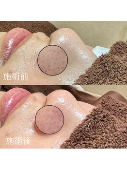 エクラ バイ シャンリィ(eclat by shanLy)/黒ずみ退散!