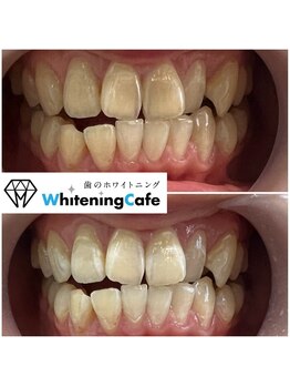 ホワイトニングカフェ 守山店/初回2回分症例写真