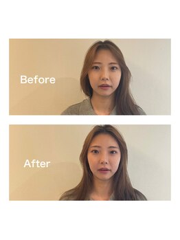 ヤマノ(YAMANO)/ベーシック美容鍼