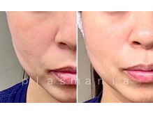 リッシュボーテ(RICHE BEAUTE)/プラズマピーリング/ビフォアフ