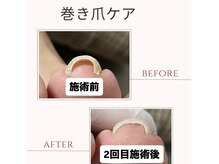 ネイルルーム カーム(nail room Calm)の雰囲気（専用プレートで巻き爪を解放、同時にジェルネイルも楽しめます！）