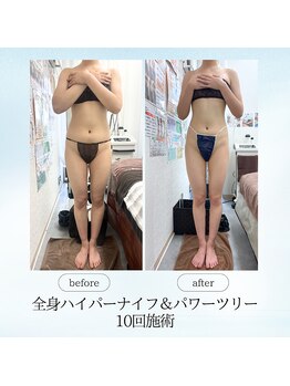 エスプレッソ(espresso,)/脂肪が取れると華奢に♪