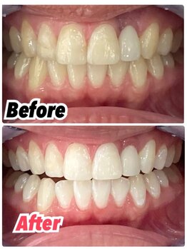 ホワイトニングスタイル 柏店/差し歯の色に合わせて白く！