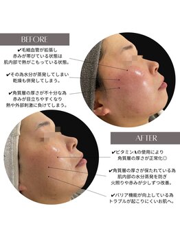 ラ クレール ビューティーサロン(LA CLAIR)/赤みアプローチ