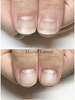 マリーロール 天王寺店(Marie Laure)/自爪育成/深爪矯正/ネイルケア