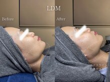 アイシス(AIsis)/【肌質改善/小顔】LDMプラチナ