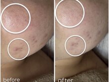 アンリミット 鹿児島天文館店(Une limit)/赤みケア