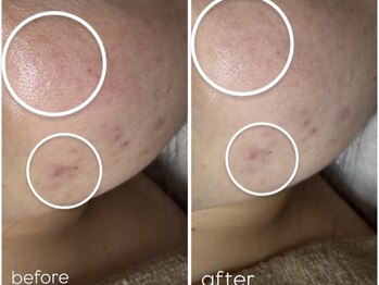 アンリミット 鹿児島天文館店(Une limit)/赤みケア