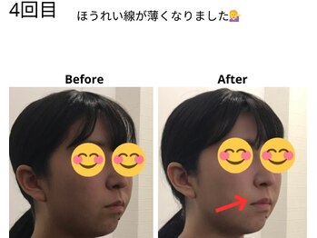 ベル/20代の方の小顔Before After