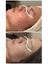 ジェニー(JENNI)/ハーブピーリング