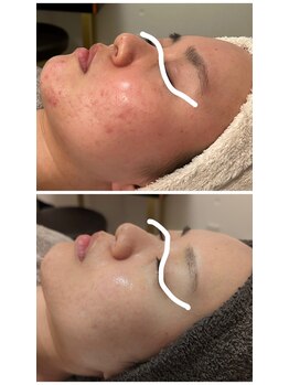 ジェニー(JENNI)/ハーブピーリング