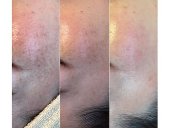 美容整骨小顔ラボ/プラズマ真皮ビフォーアフター