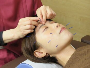 モグ(MOGU)の写真/【早めのエイジングケア】フェイシャル美容鍼◇気になる美容鍼や身体のお悩みは女性施術者にお任せ♪