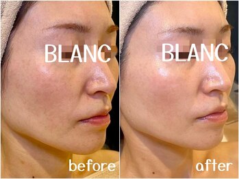 サロン ド ブラン アオヤマ(Salon de BLANC AOYAMA)/クリスティーナ美白ケア90分