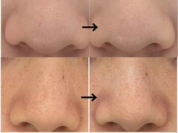 ビーアヴニール(B.Avenir)/小鼻の黒ずみ、角栓ケア