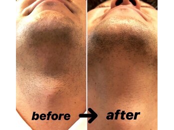 ボス 犬山店(BOSS)/【ヒゲ脱毛】※3回施術後　#脱毛