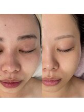 リトルーム(Litroom: from Seoul)/VVSトリートメント