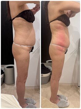 ありひ/セルゼロの効果！！