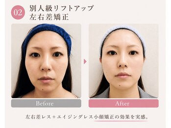 モアフェイス 池袋店(More Face)/小顔矯正　左右差　リフトアップ