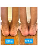 コハク(kohaku)/ビフォーアフター