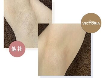 キュート 本店/当サロン脱毛器と他社との違い！