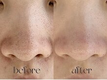 シュリ(Shri)/毛穴撃退フルコース