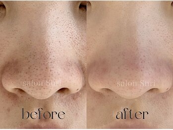 シュリ(Shri)/毛穴撃退フルコース