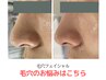 【毛穴洗浄エステ】引き締め・詰まり・年齢毛穴/プラズマコース90分
