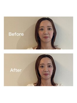 ヤマノ(YAMANO)/ベーシック美容鍼