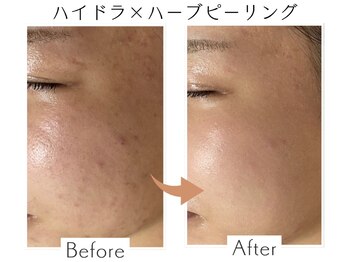 ベル(Belle)/ハイドラ×ハーブピーリング