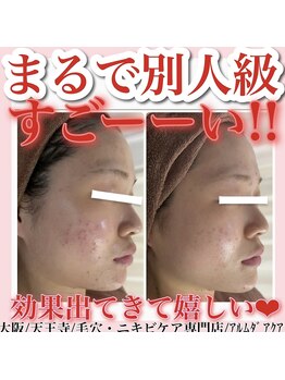 アルムダアクア 天王寺店(Aleumda AQUA)/ハーブピーリング/大阪/天王寺