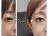 【THRひかりフェイシャル】目がぱっちり/ほうれい線,細胞活性化,毛穴,赤み◎