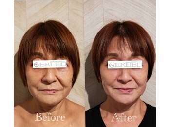 エクボ 立川店(EKUBO)/たるみすっきり!!トーンアップ!!