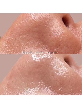 セレン(Seren)/大人気の毛穴洗浄が¥3500ッ♪