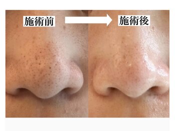 ロッティ アイラッシュ(lotti eyelash)/【人気No.1毛穴ケア】